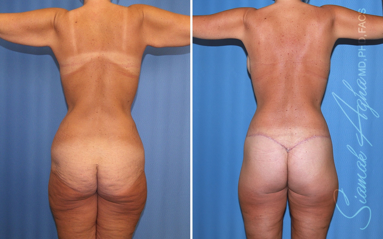 orange county total body lift patient 56 back Newport Beach, CA