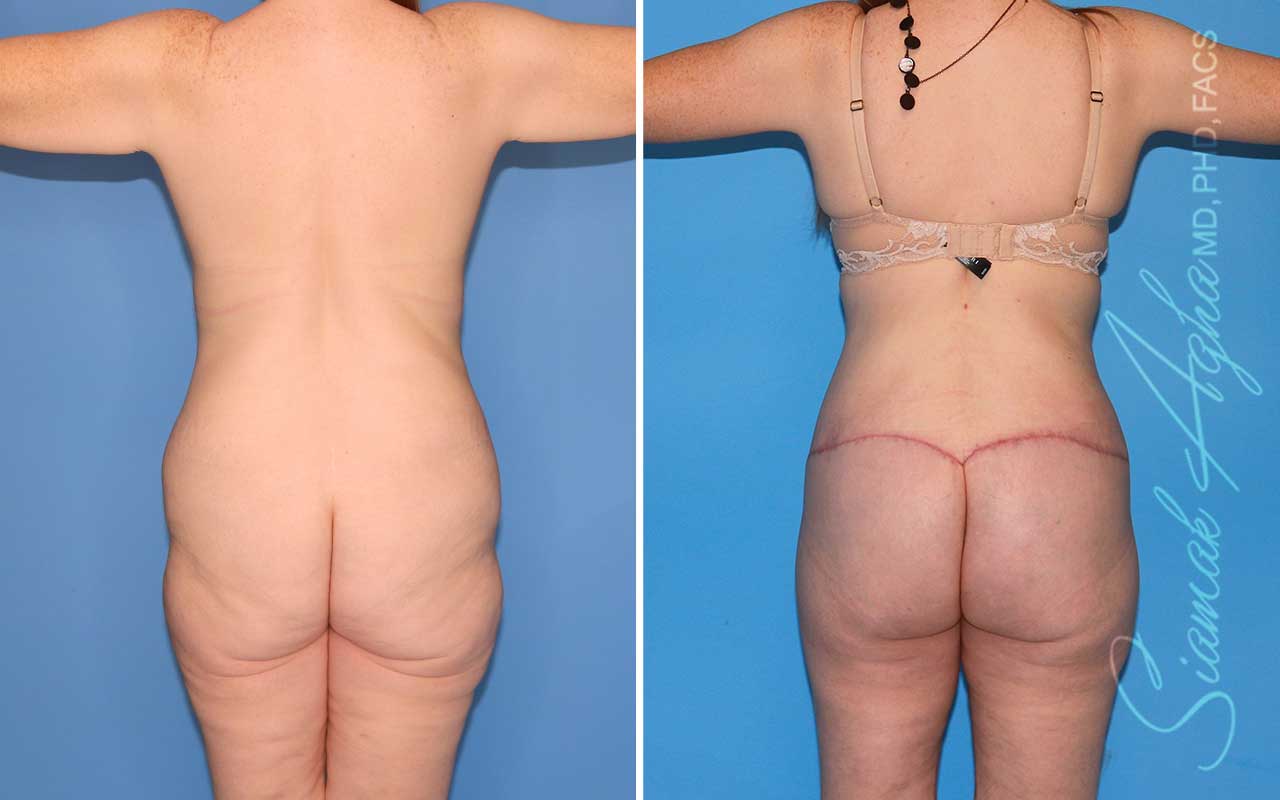 orange county total body lift patient 57 back Newport Beach, CA