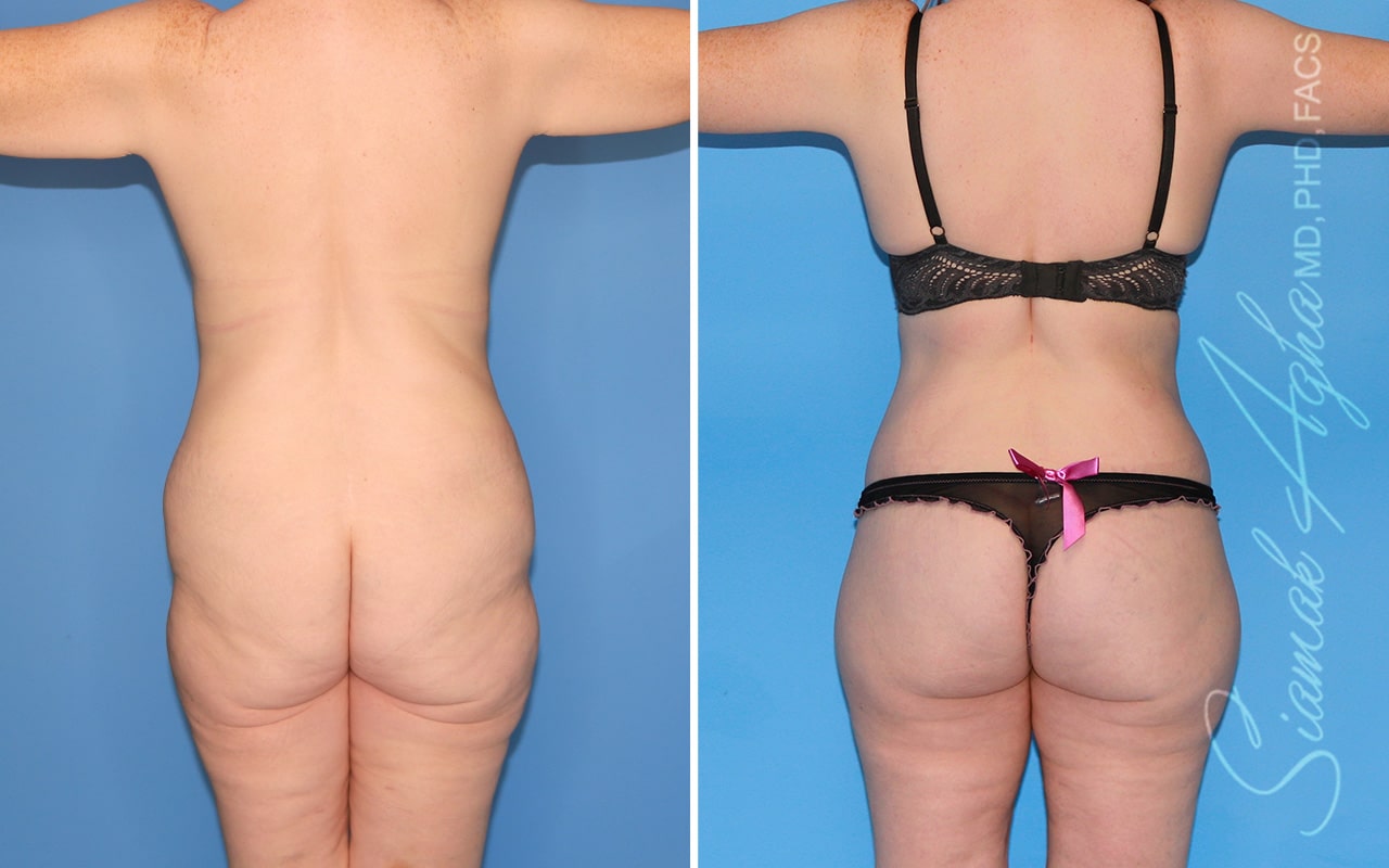 orange county total body lift patient 59 back Newport Beach, CA