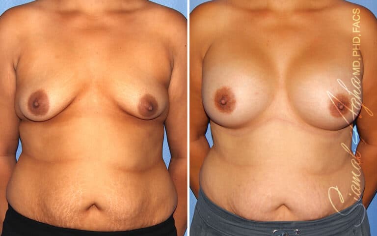 Tubular Breast Correction