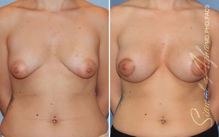 Tubular Breast Correction