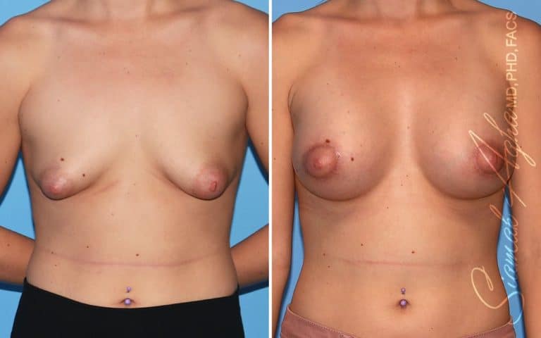 Tubular Breast Correction