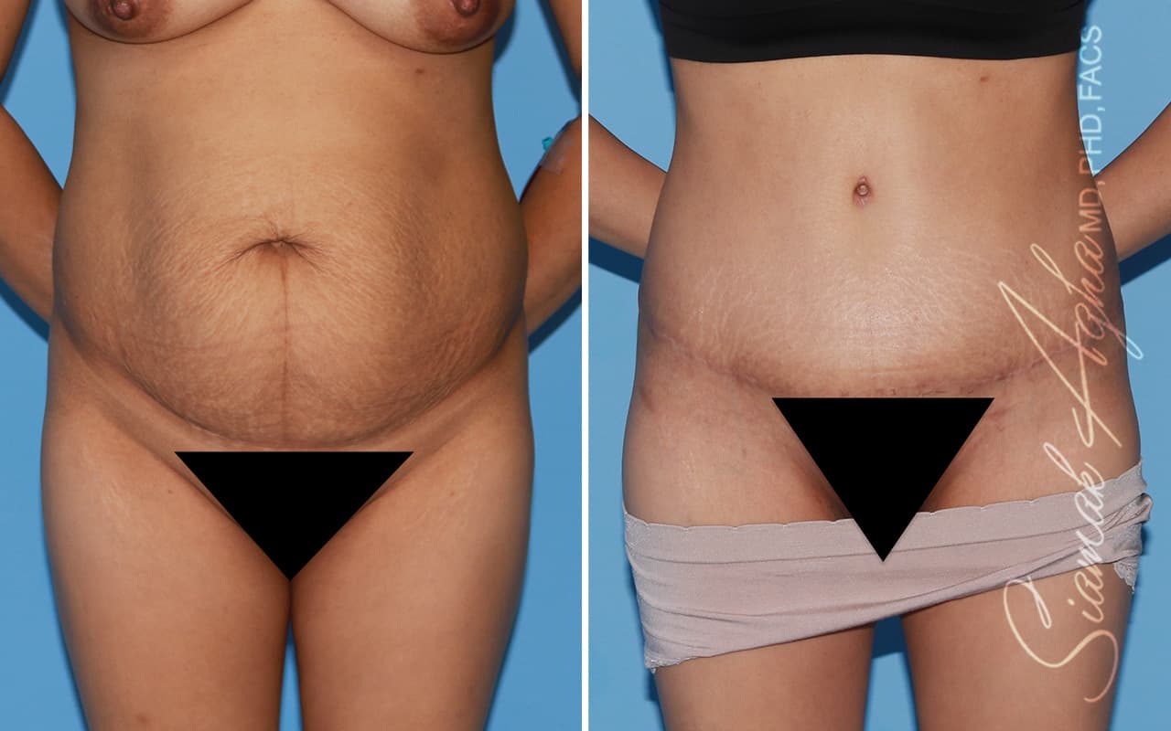 Tummy Tuck