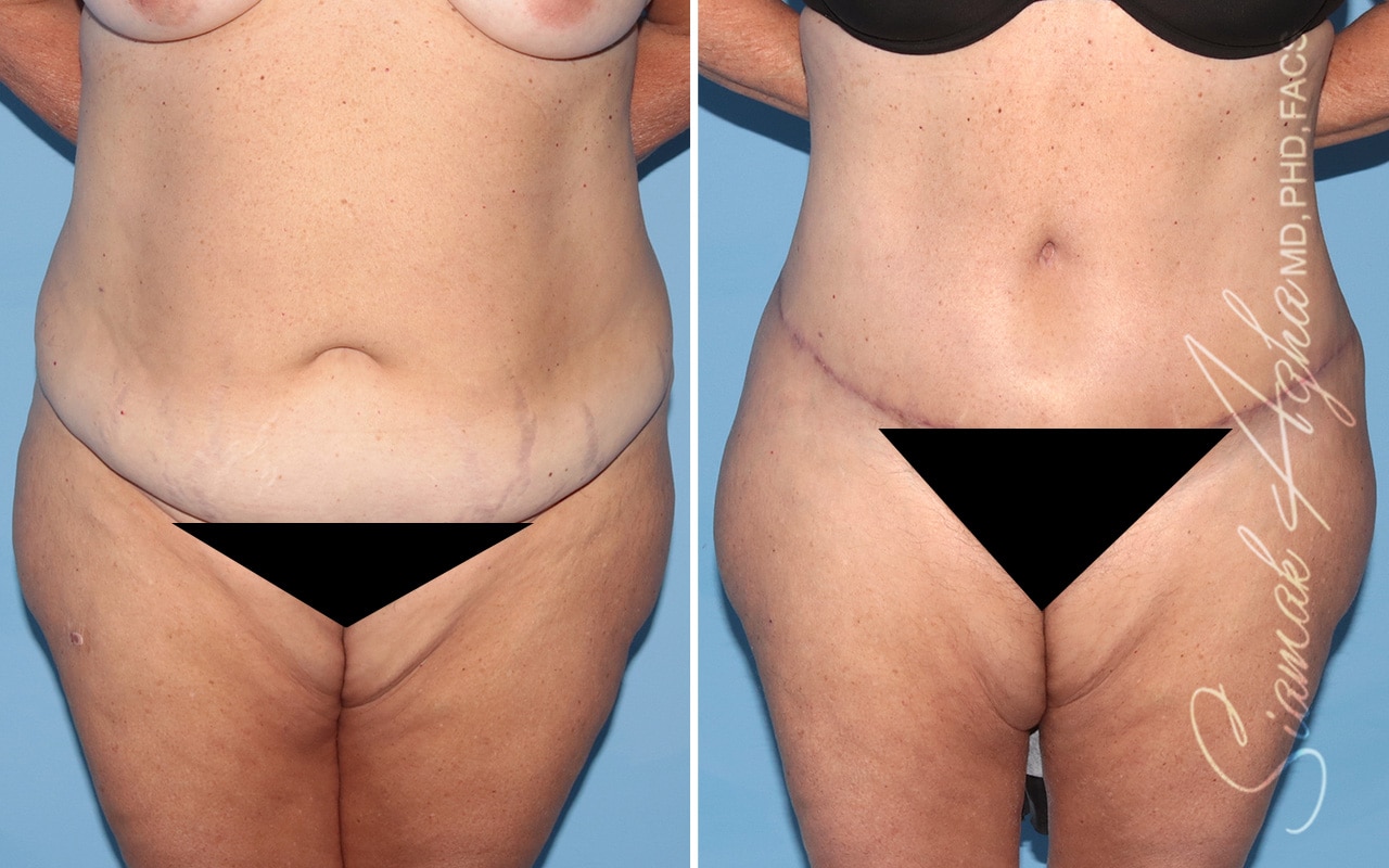 Plus Size Tummy Tuck