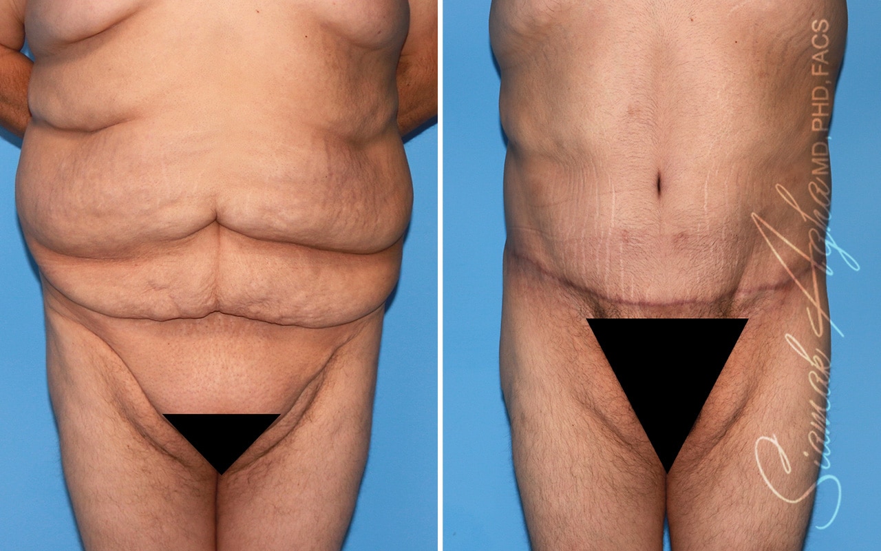 Plus Size Tummy Tuck