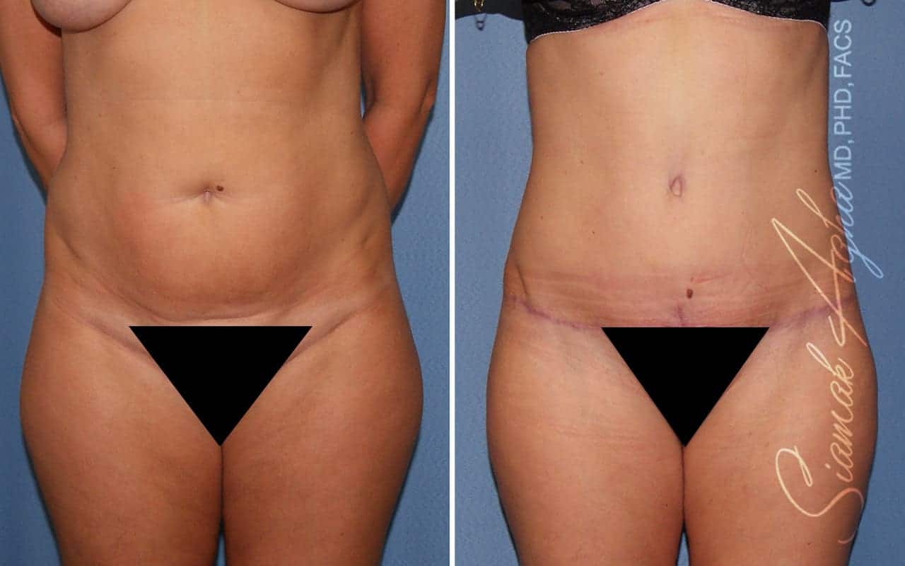 Partial Tummy Tuck