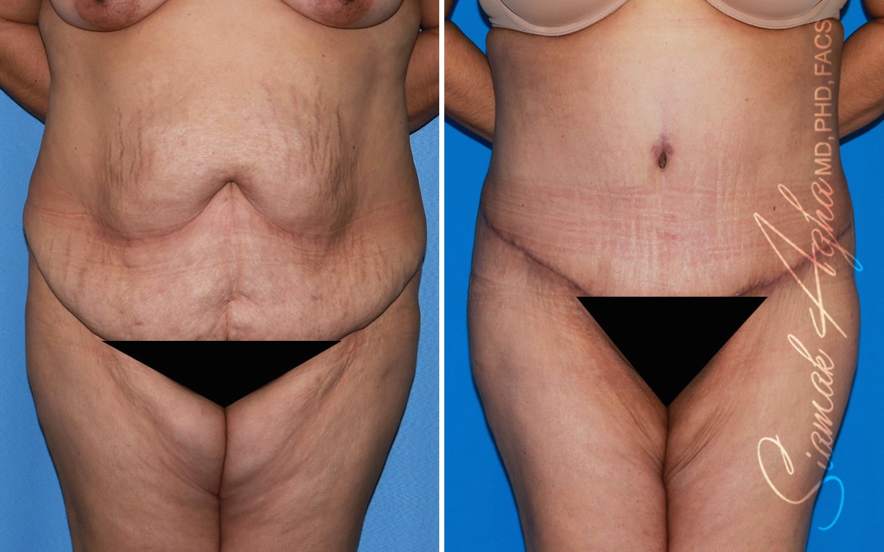 Plus Size Tummy Tuck