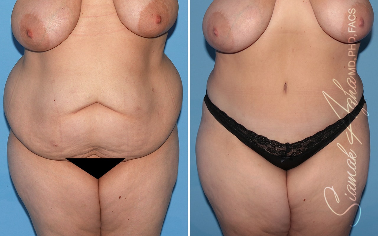 Plus Size Tummy Tuck