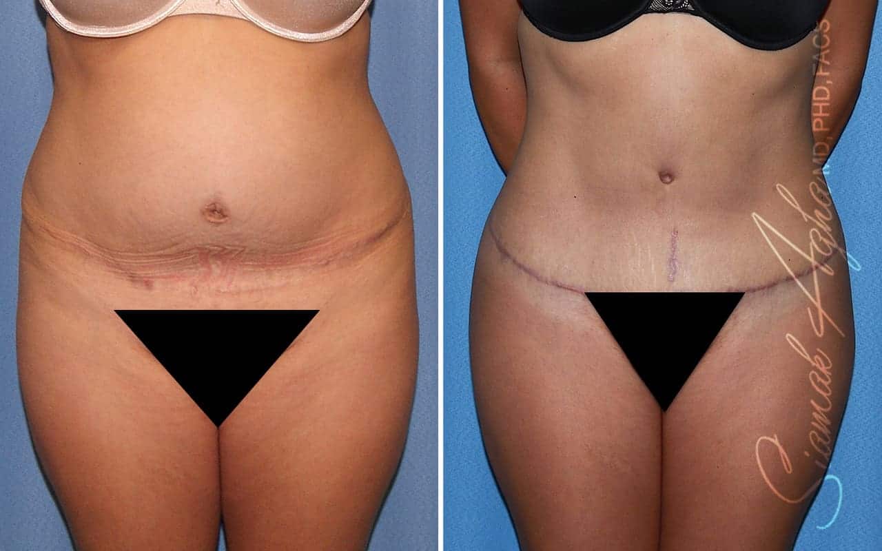 Tummy Tuck Revision