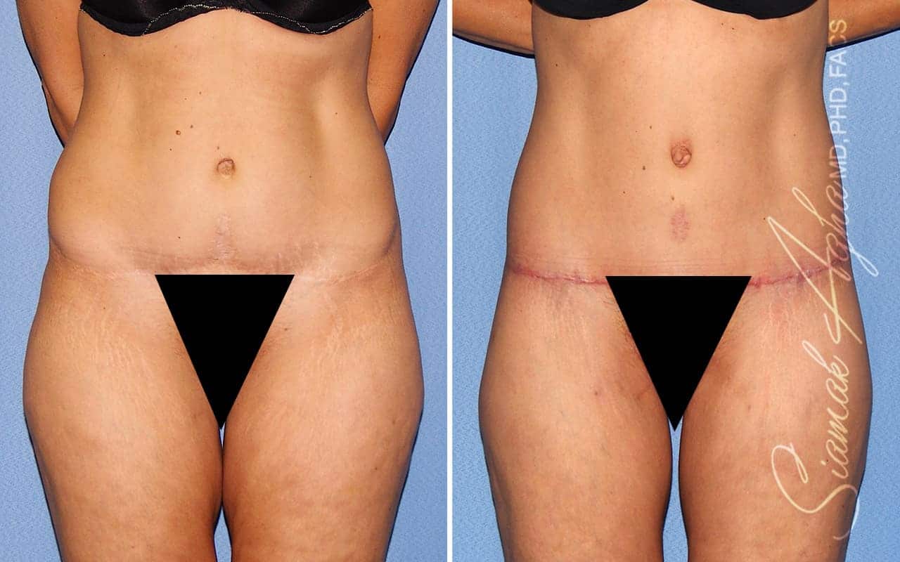 Tummy Tuck Revision