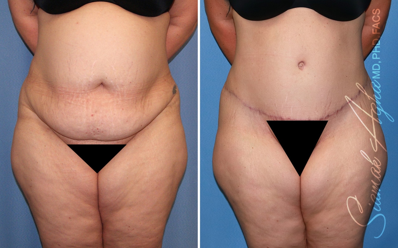 Plus Size Tummy Tuck