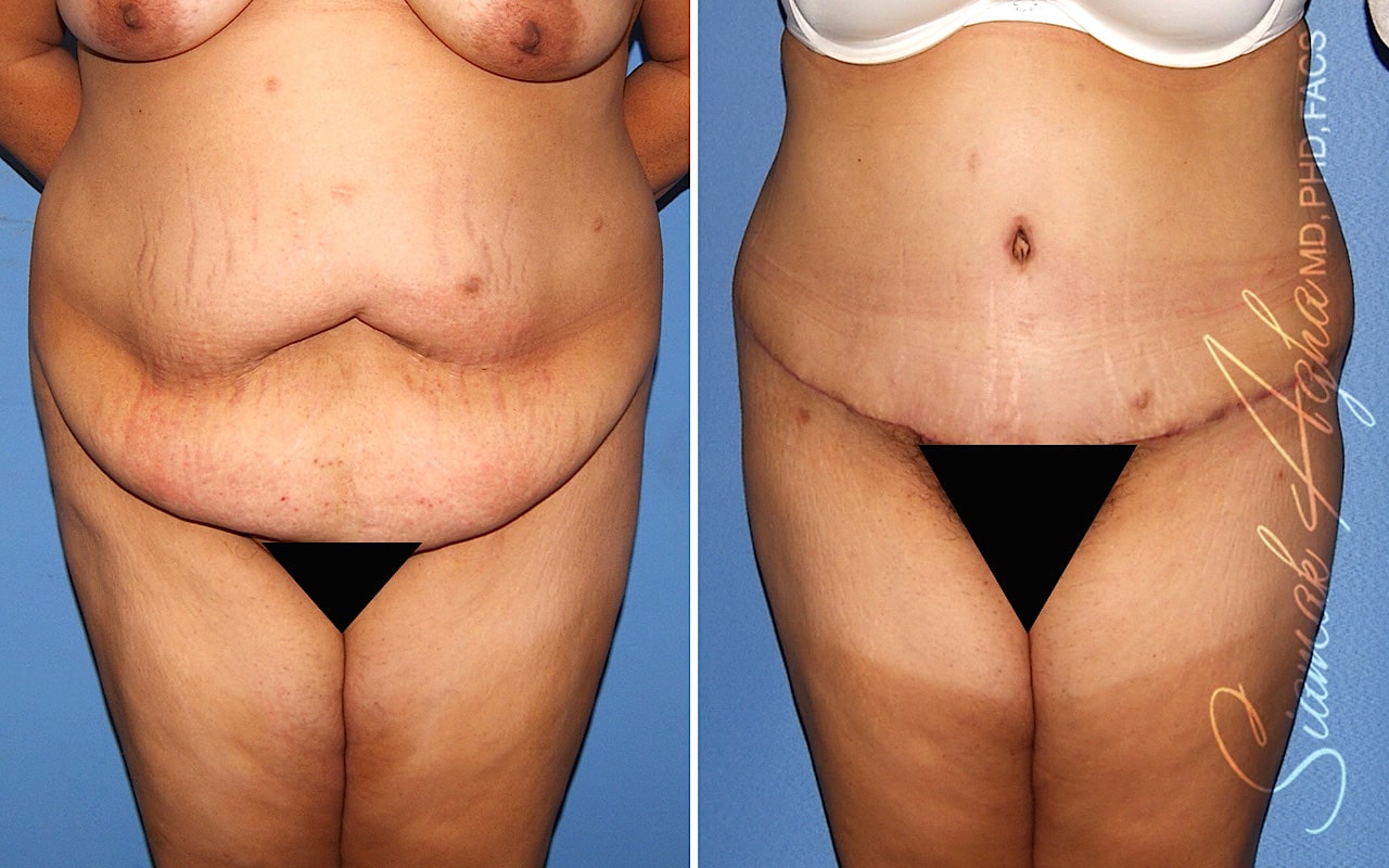 Plus Size Tummy Tuck