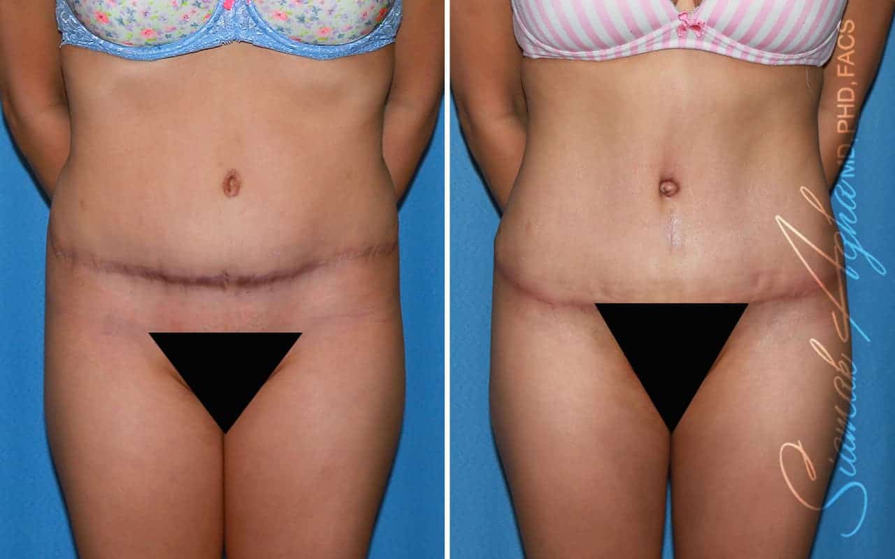 Tummy Tuck Revision