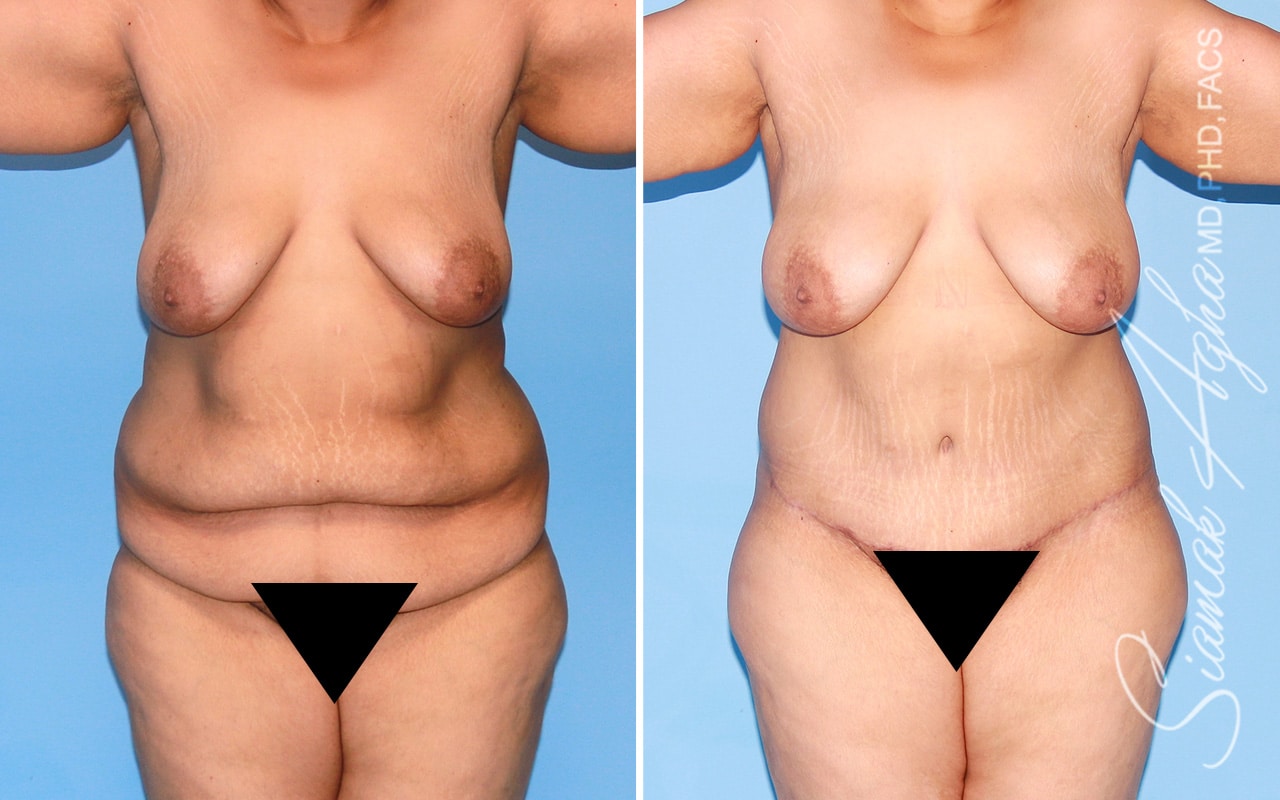 Plus Size Tummy Tuck