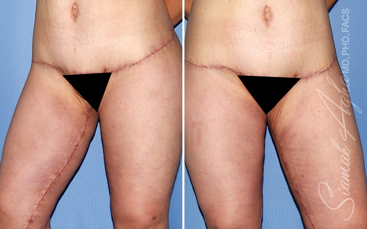 orange county vertical thigh lift patient 06 Newport Beach, CA