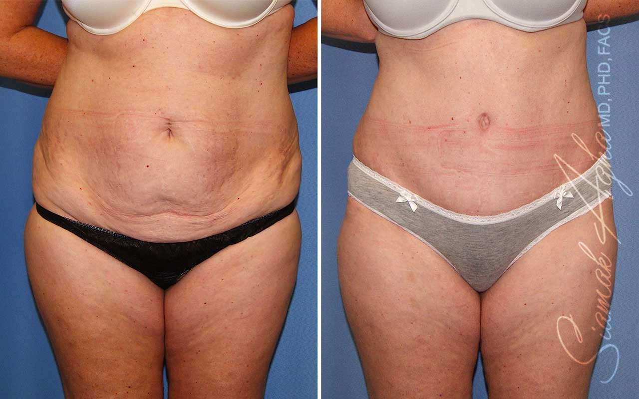 Tummy Tuck