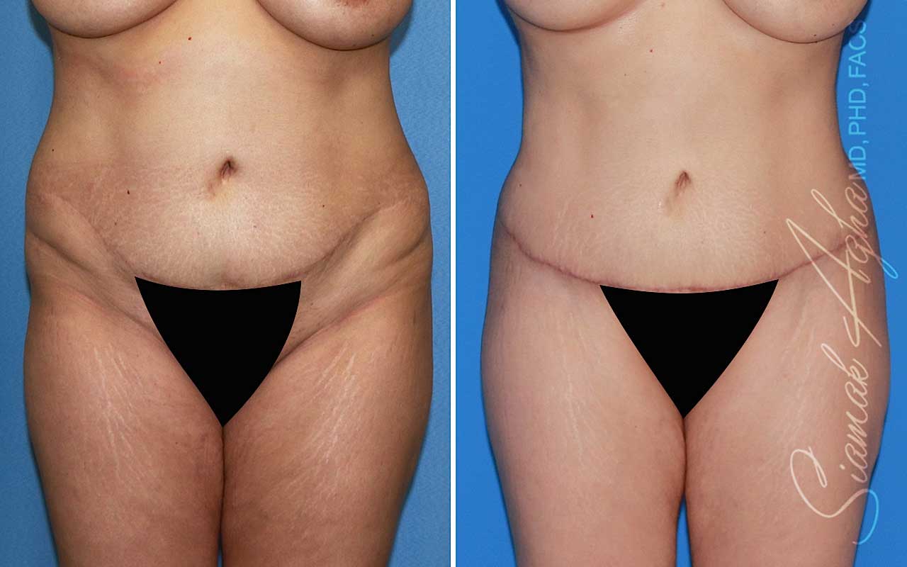 Tummy Tuck