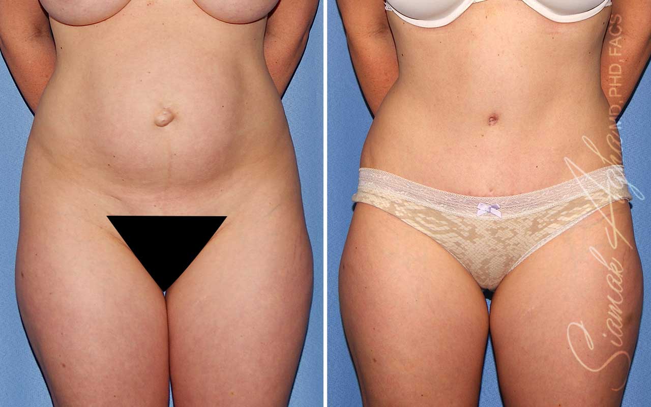 Tummy Tuck