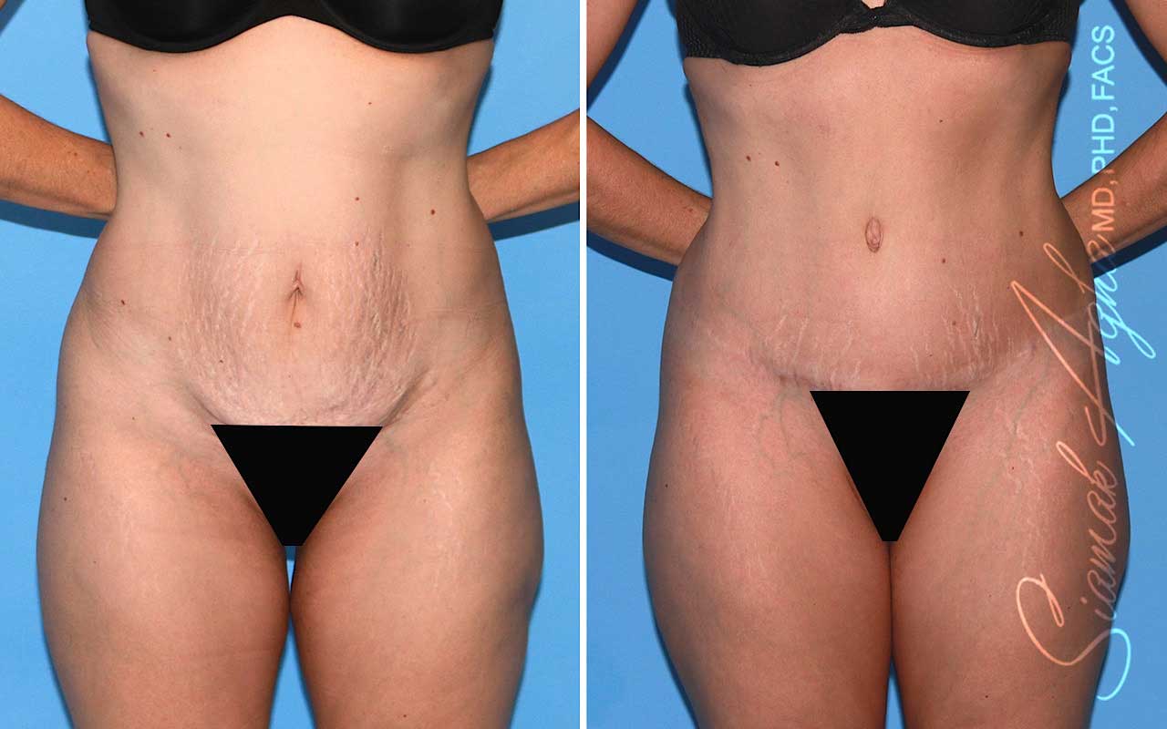 Tummy Tuck