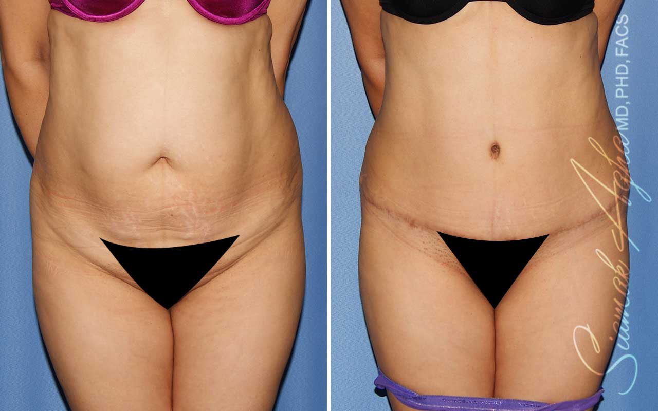 Tummy Tuck