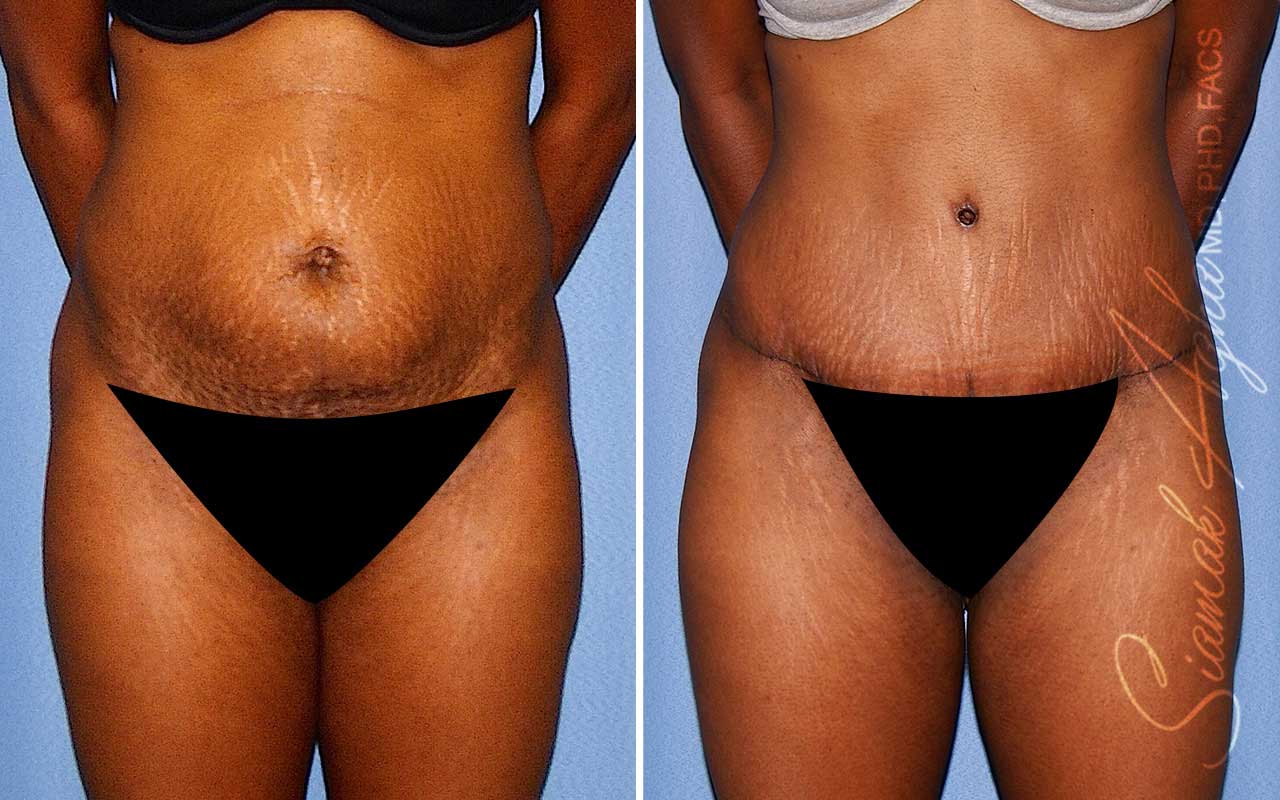 Tummy Tuck