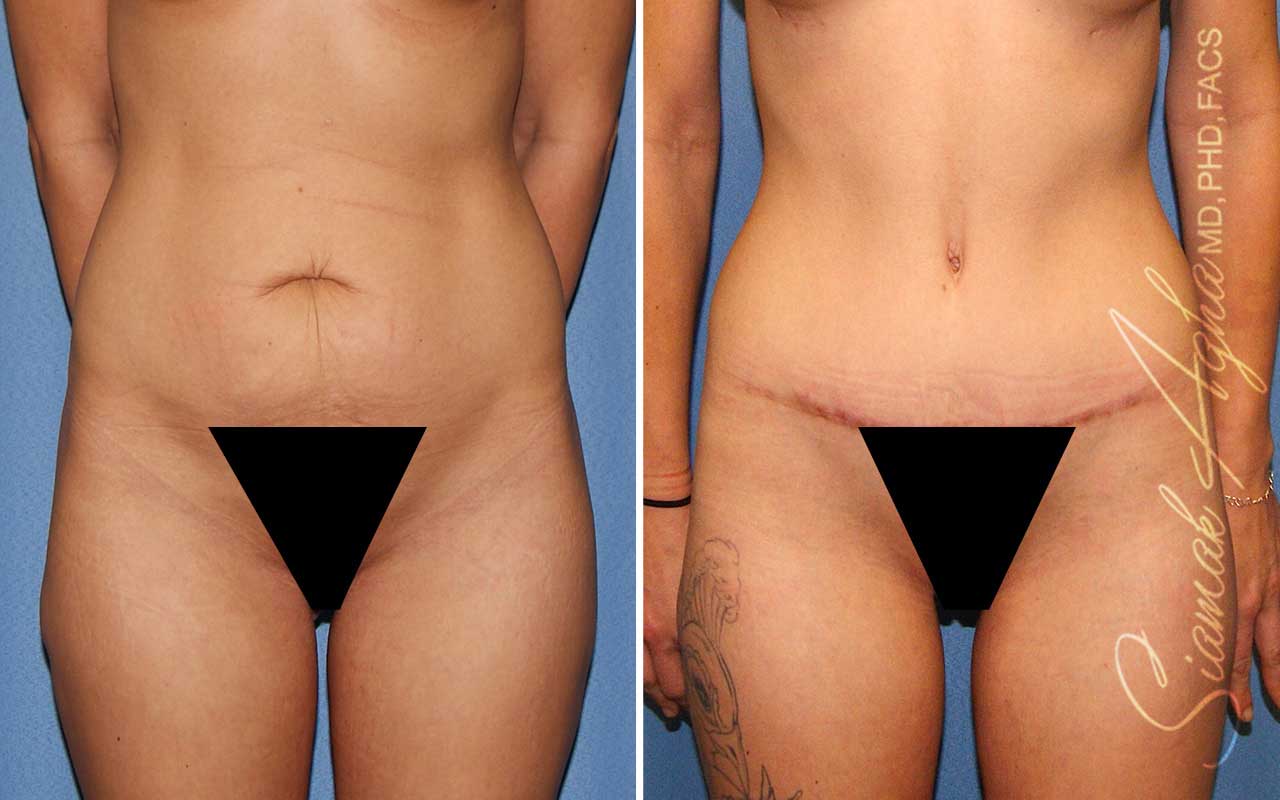 Tummy Tuck