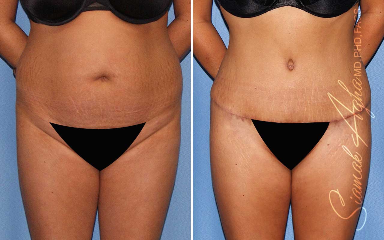 Tummy Tuck