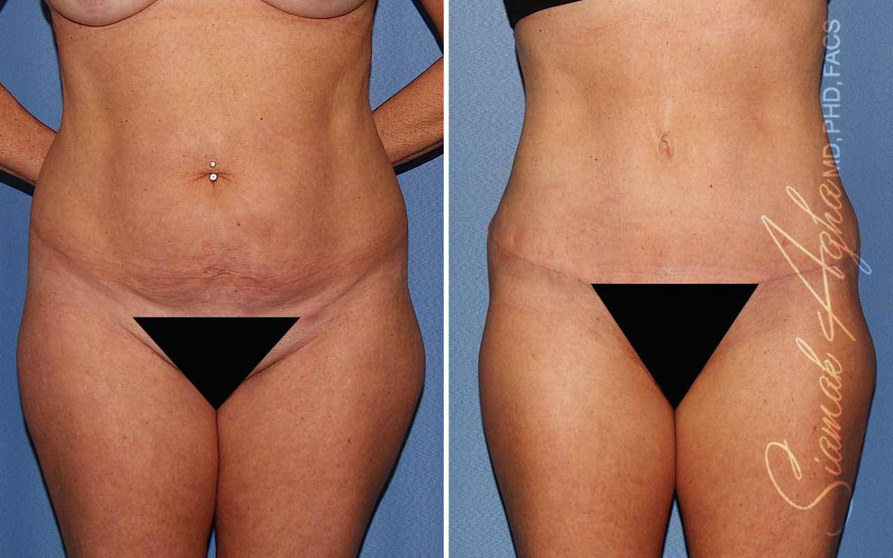 Tummy Tuck