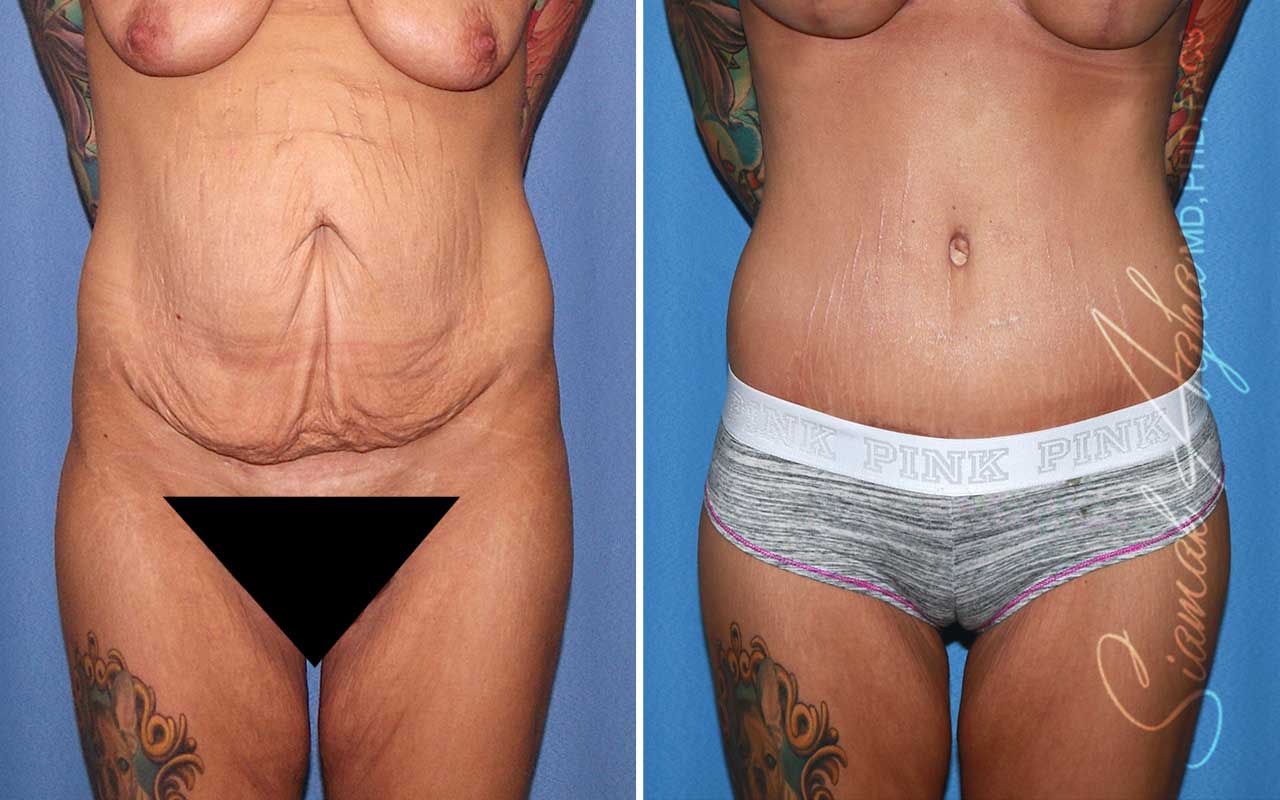 Tummy Tuck