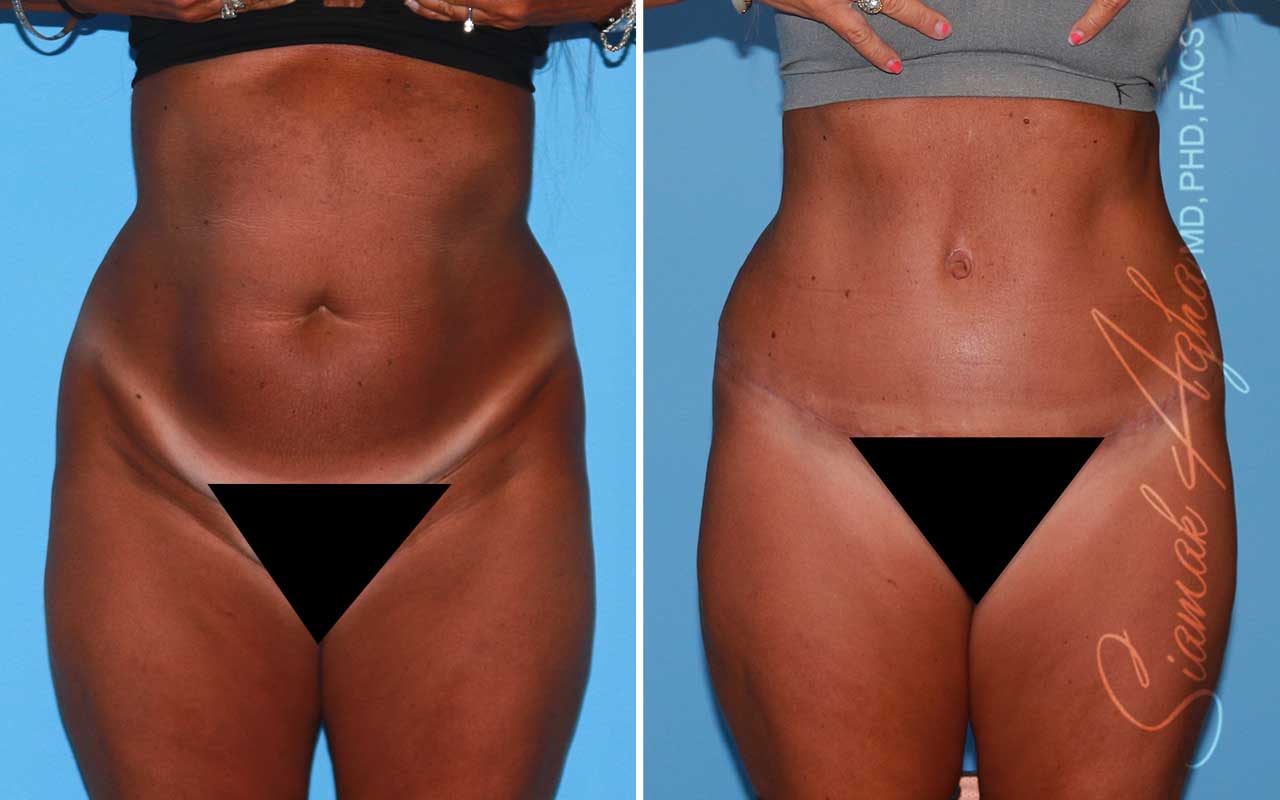 Tummy Tuck