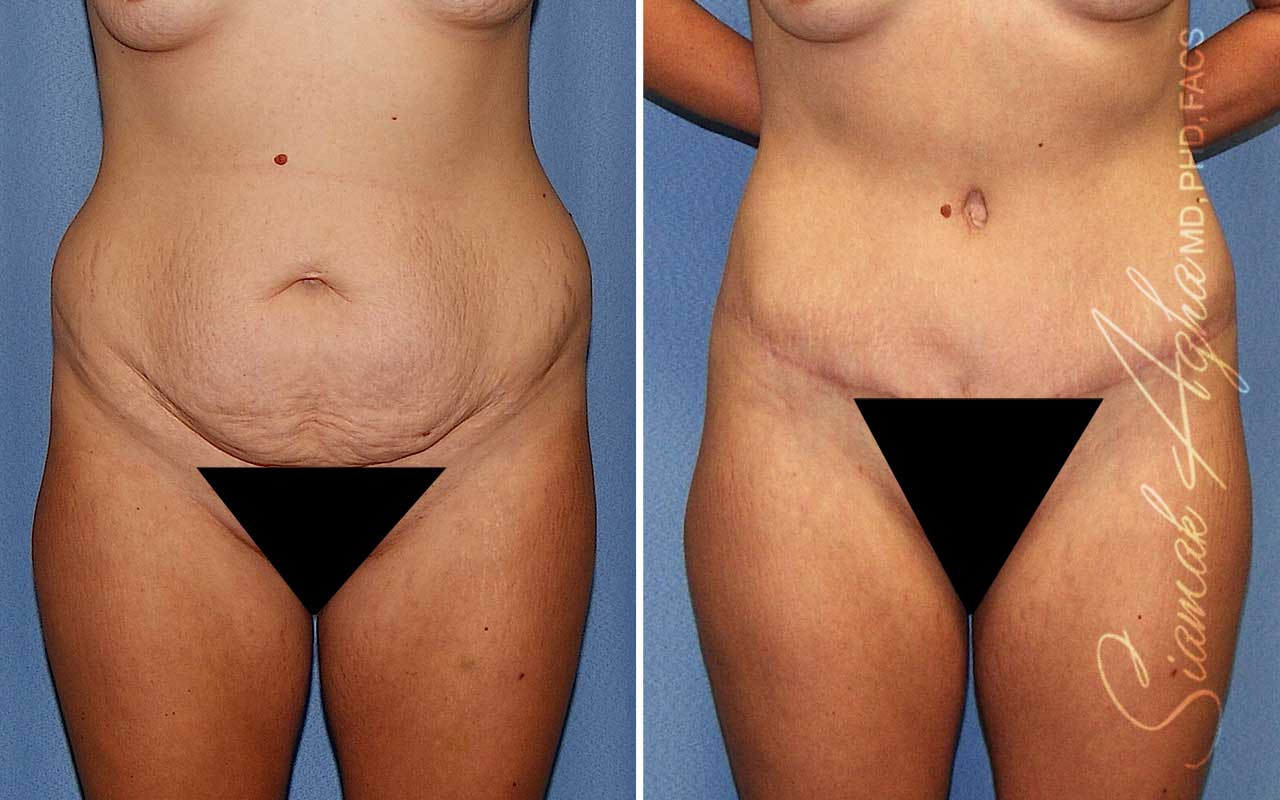 Tummy Tuck