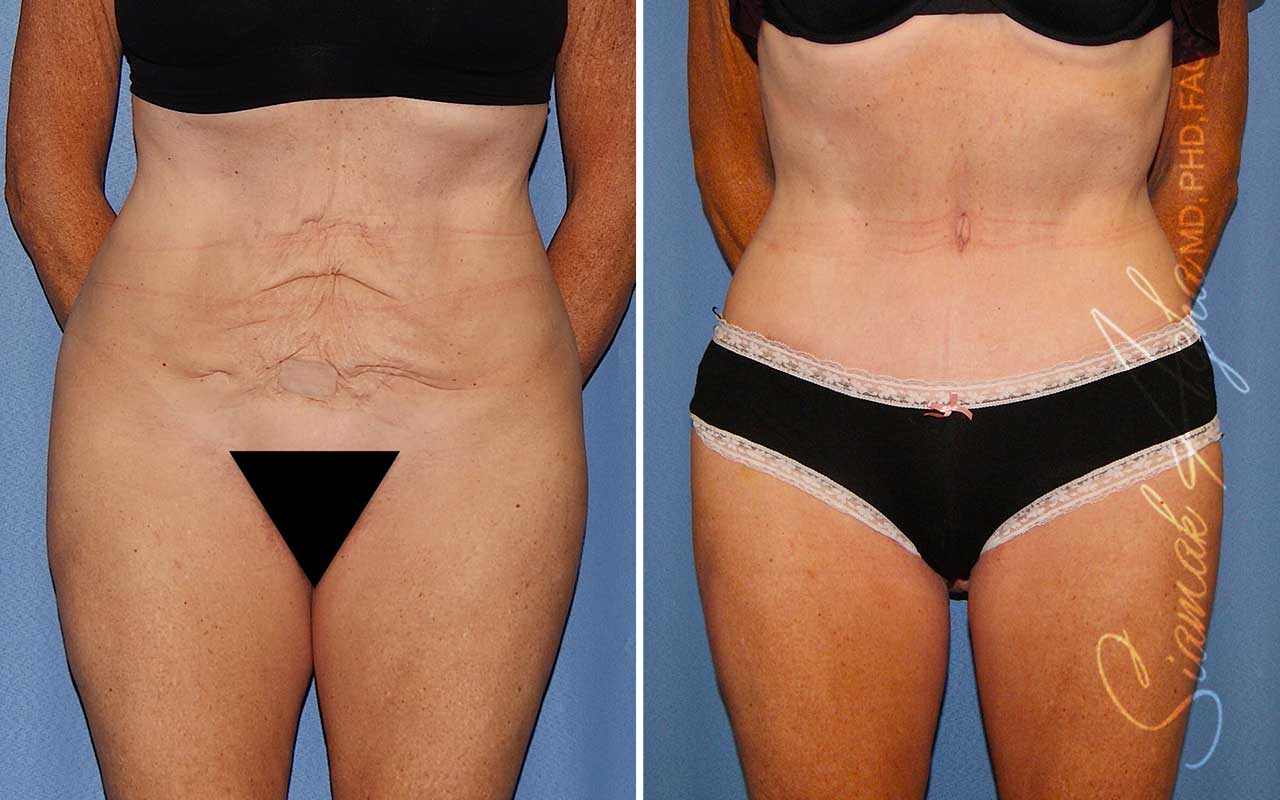 Tummy Tuck