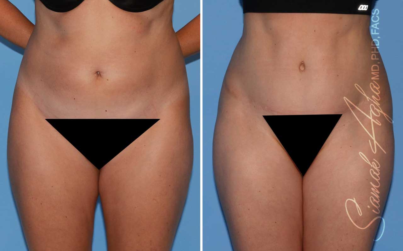 Tummy Tuck