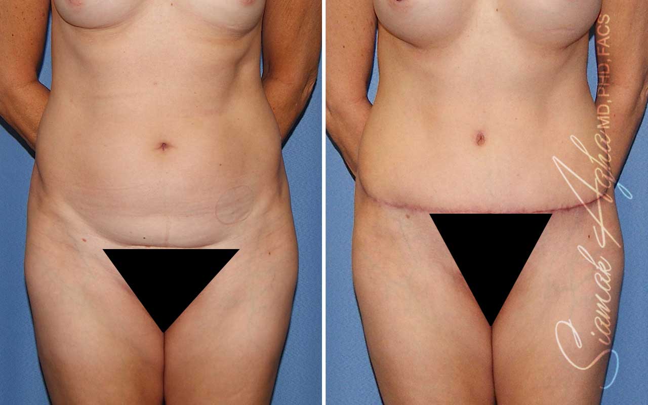 Tummy Tuck