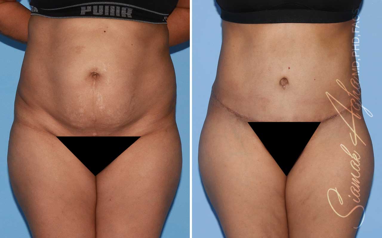 Tummy Tuck