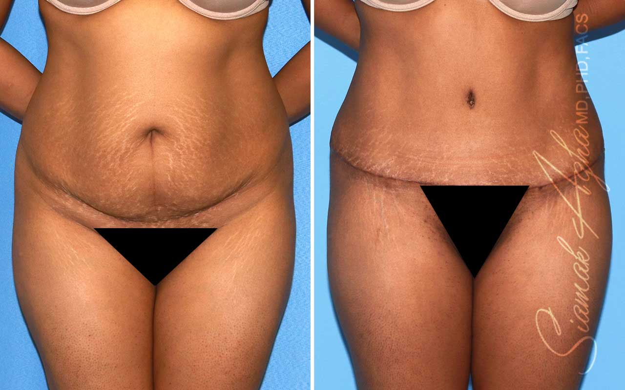 Tummy Tuck