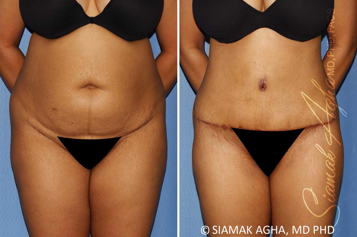 Tummy Tuck