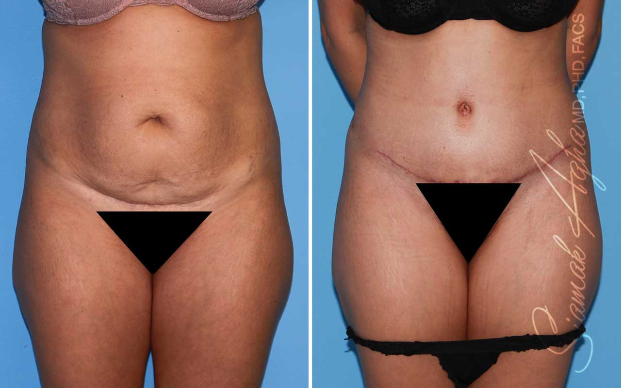 Tummy Tuck