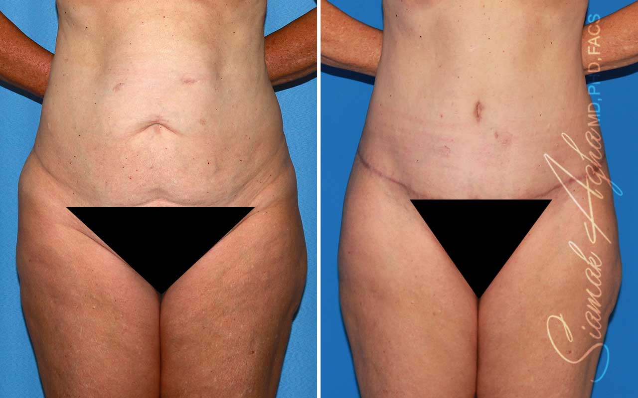 Tummy Tuck