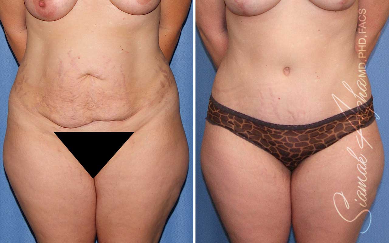 Tummy Tuck