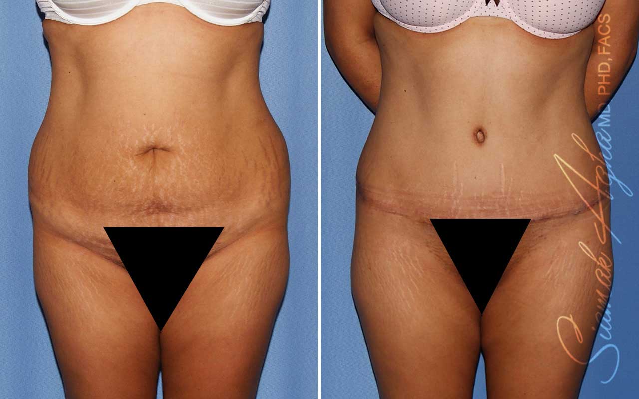 Tummy Tuck