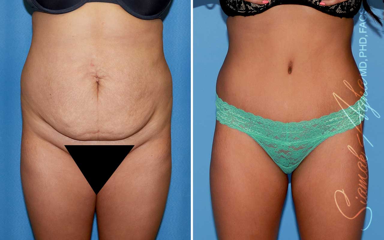 Tummy Tuck