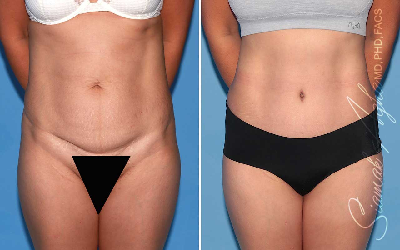 Tummy Tuck