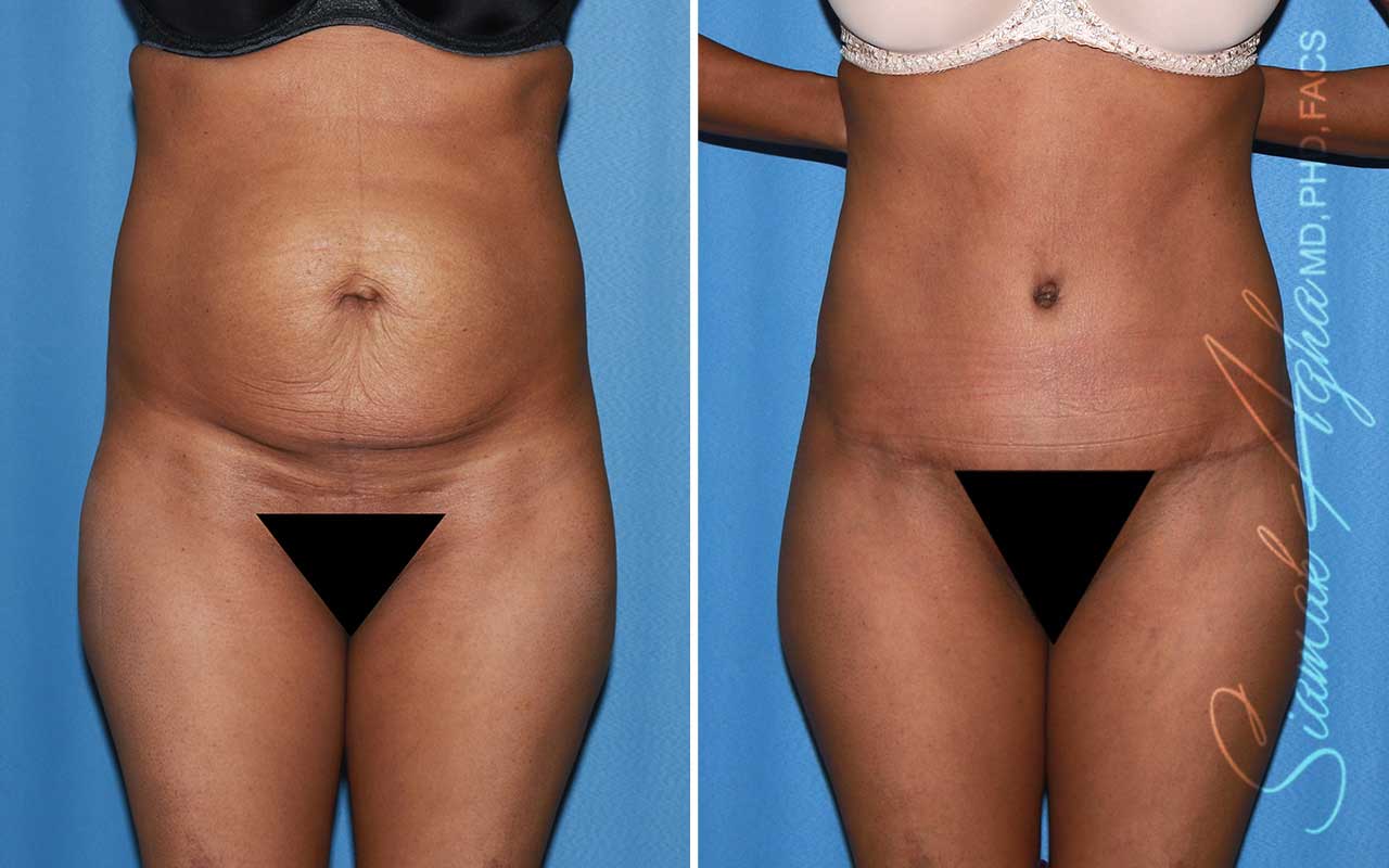 Tummy Tuck