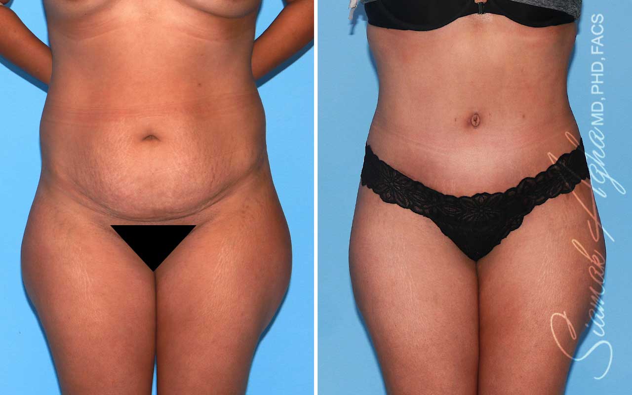 Tummy Tuck