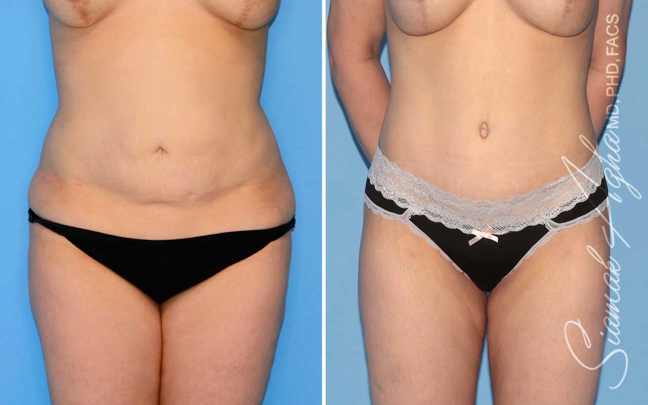 Tummy Tuck