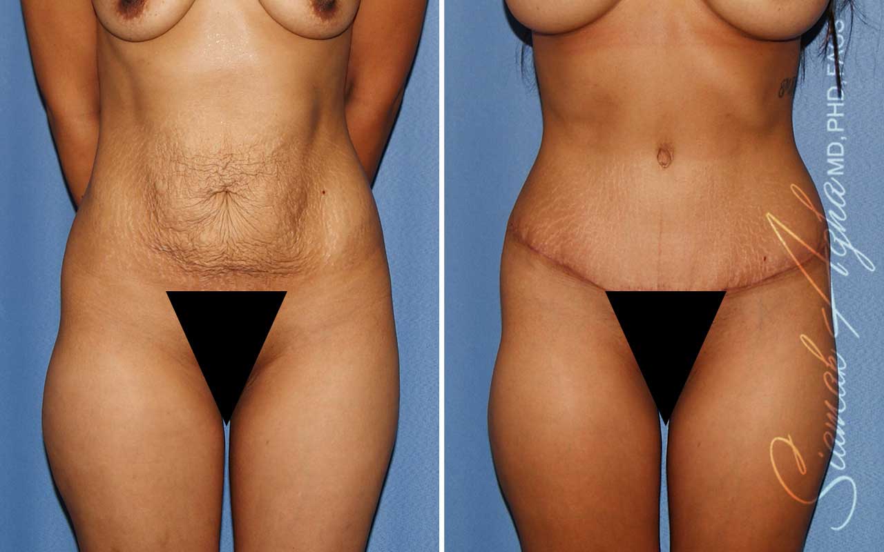 Tummy Tuck