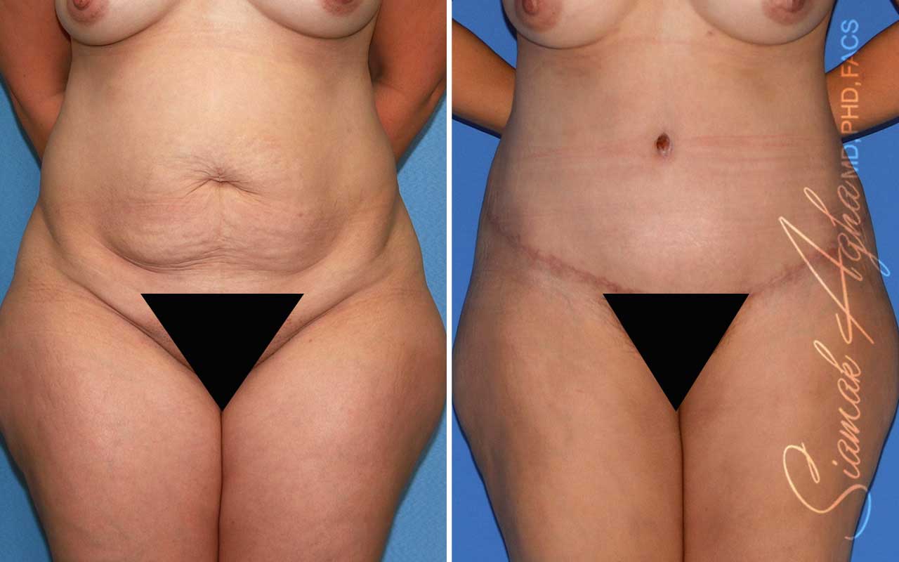 Tummy Tuck