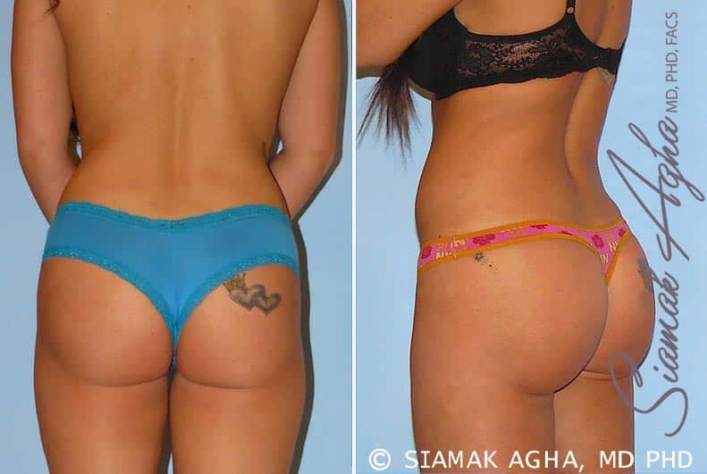 Orange County Brazilian Butt Lift Patient 12 Back Left Newport Beach, CA