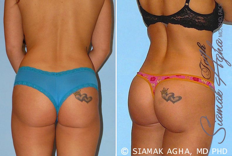 Orange County Brazilian Butt Lift Patient 12 Back Right Newport Beach, CA